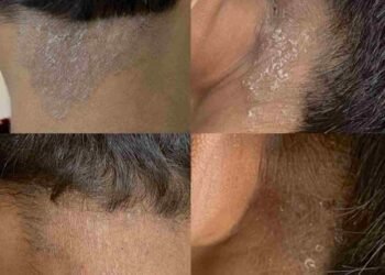 psoriasis laser treatment, Neo Elite laser, psoriasis breakthrough India, non-invasive psoriasis care