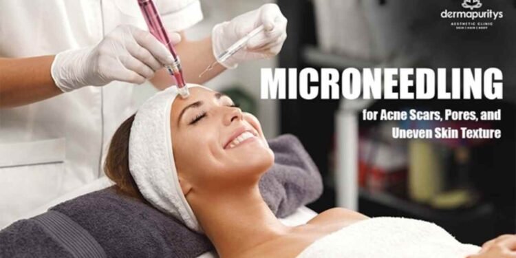 microneedling for acne scars, skin repair treatment, collagen therapy, dermatologist treatment